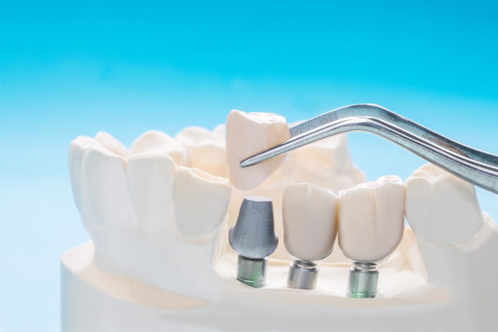 Dental Implant in Midland, Texas