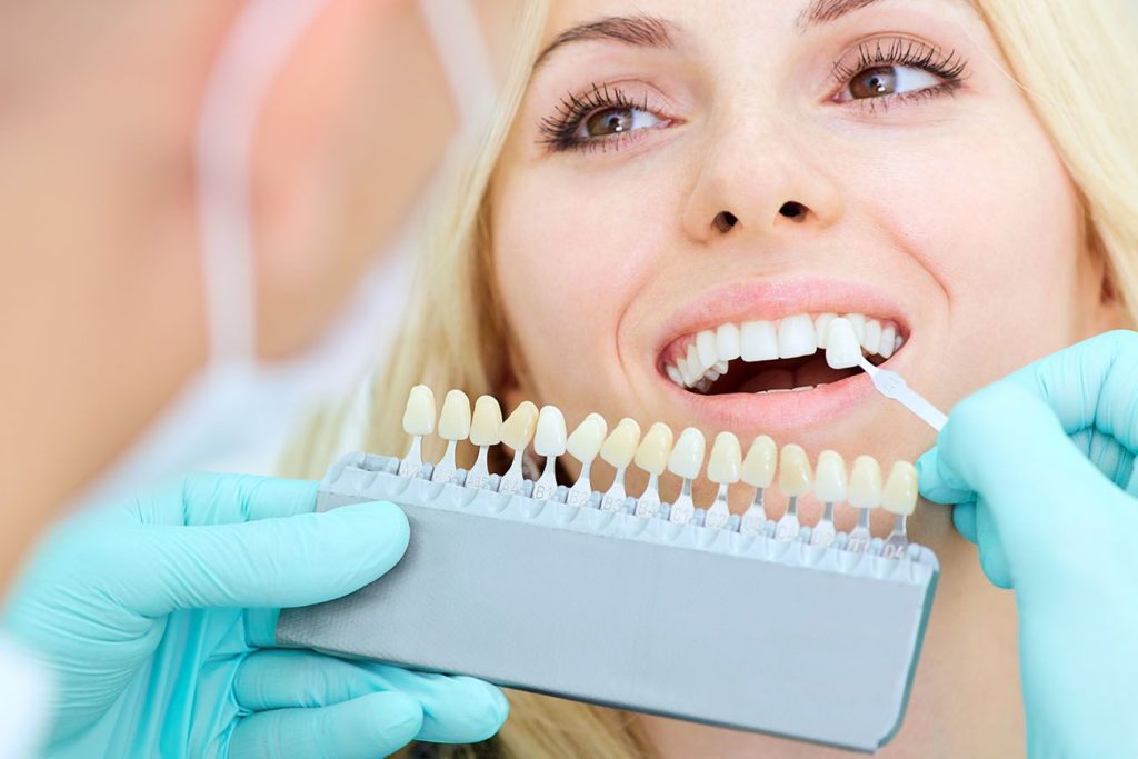 porcelain veneers aftercare in Midland Texas