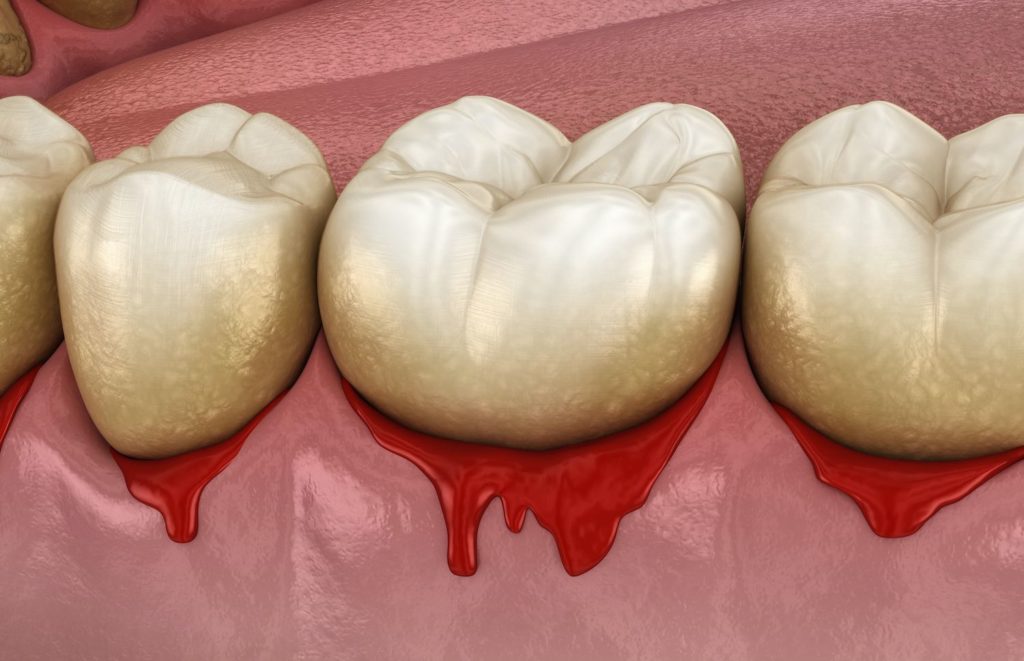 bleeding gums Midland Texas