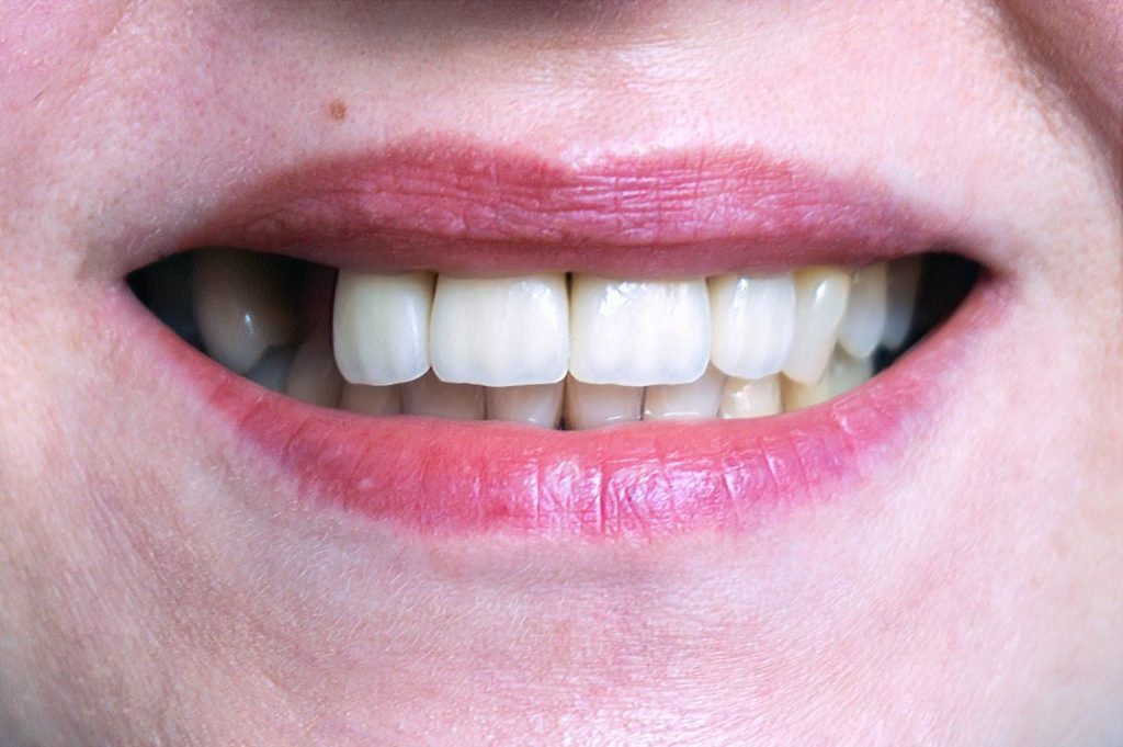 treat tooth loss with restorative dentistry