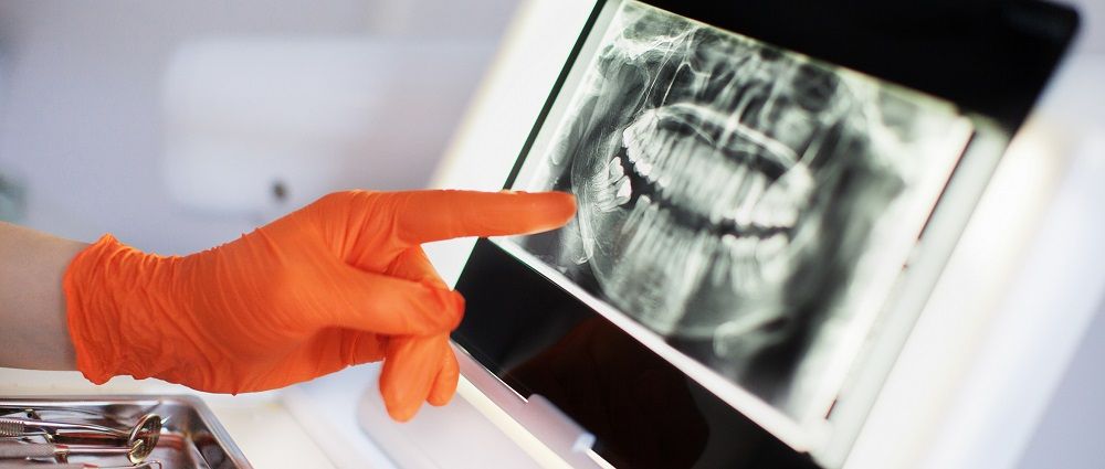 wisdom teeth growth in dental x-ray