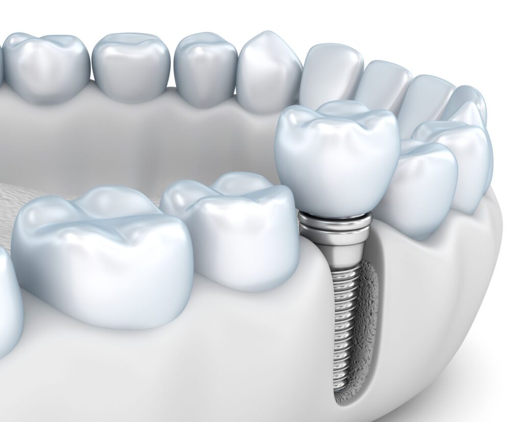 preserve jaw structure with dental implants