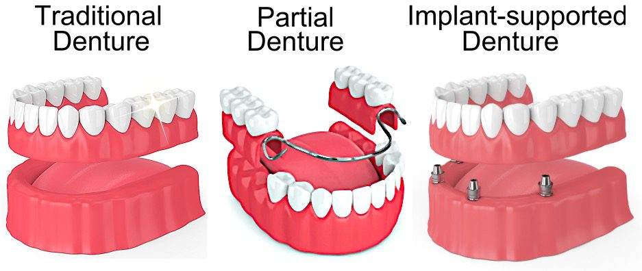 types of dentures image