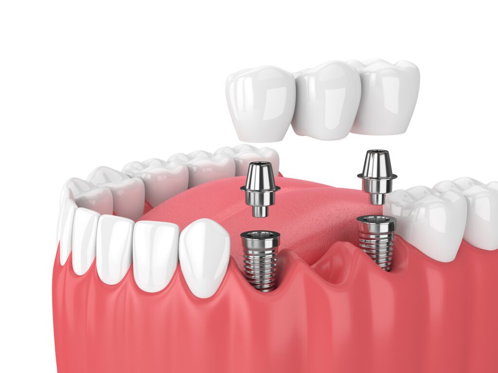 parts of a dental implant in Midland, TX