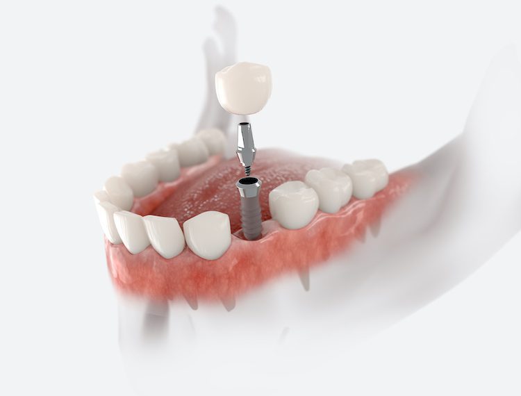 Understanding the nuances of insurance coverage for dental implants can be complex, but it's crucial for making informed decisions.