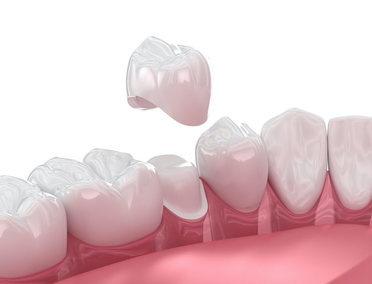 Understanding what to expect when getting a dental crown could help reduce anxiety and ensure you get the treatment you need.